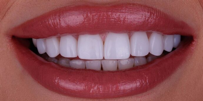 Smile Design Cases Case 2 - After