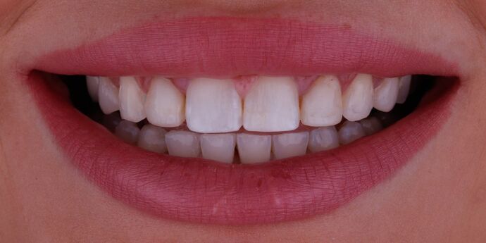 Smile Design Cases Case 2 - Before