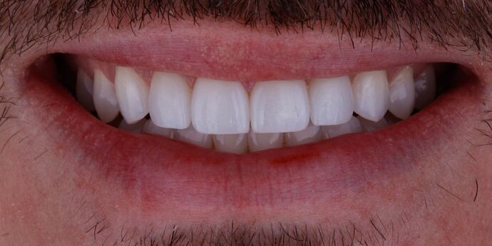 Smile Design Cases Case 3 - After