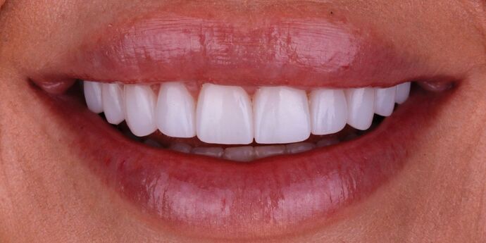 Smile Design Cases Case 4 - After