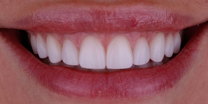 Smile Design Cases Case 5 - After