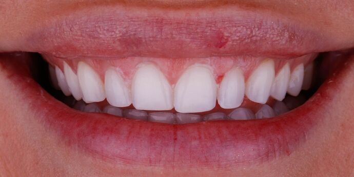 Smile Design Cases Case 5 - Before