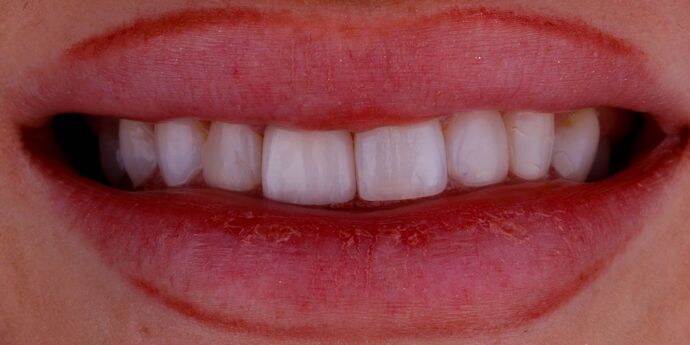 Smile Design Cases Case 6 - Before