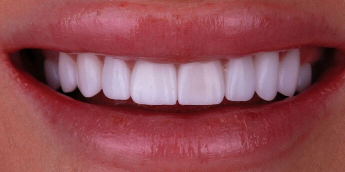 Smile Design Cases Case 6 - After