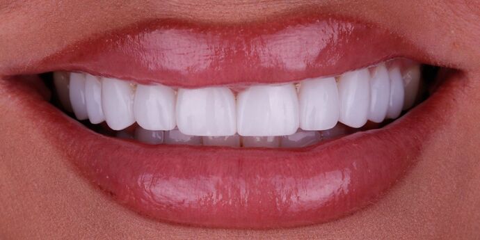 Smile Design Cases Case 7 - After