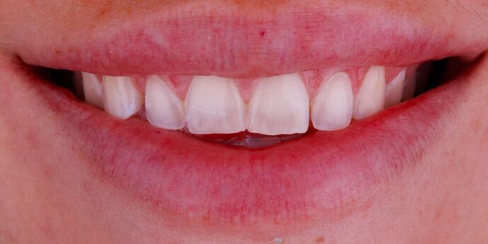 Smile Design Cases Case 9 - Before