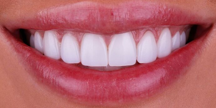 Smile Design Cases Case 9 - After