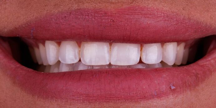 Smile Design Cases Case 10 - Before