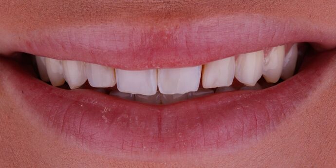 Smile Design Cases Case 11 - Before