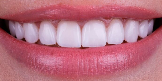 Smile Design Cases Case 13 - After