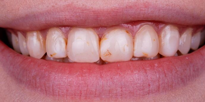 Smile Design Cases Case 13 - Before