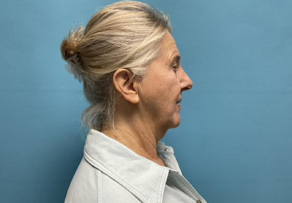 Facelift: Case 3 - Before