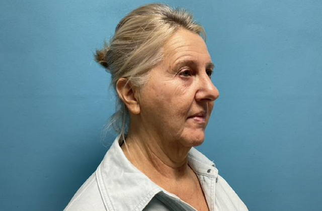 Facelift: Case 3 - Before