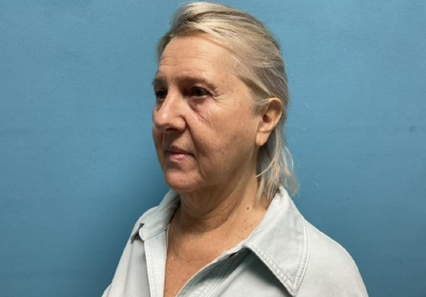 Facelift: Case 3 - Before