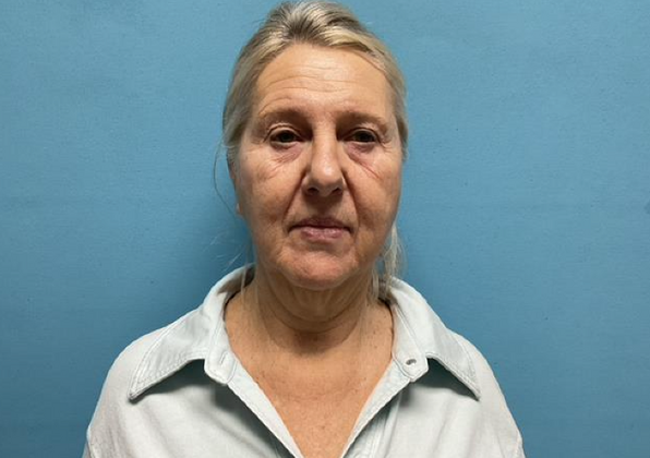 Facelift Case 3 - Before