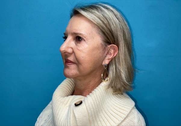 Facelift: Case 3 - After