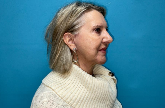 Facelift: Case 3 - After