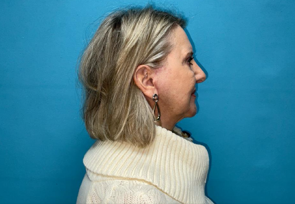 Facelift: Case 3 - After