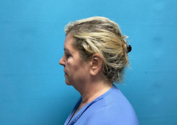 Facelift: Case 9 - Before