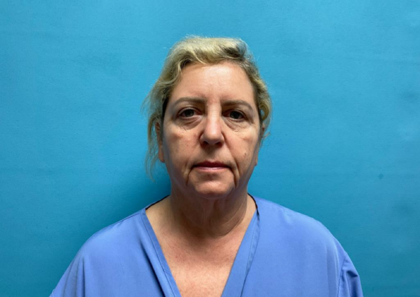 Facelift Case 9 - Before