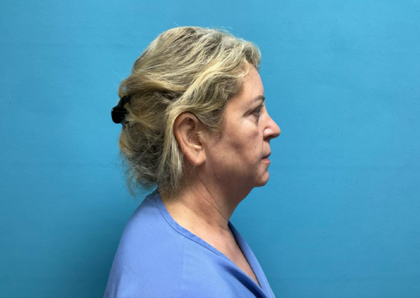 Facelift: Case 9 - Before