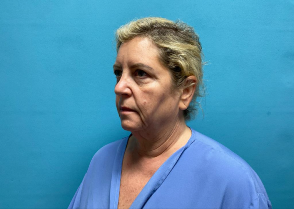 Facelift: Case 9 - Before