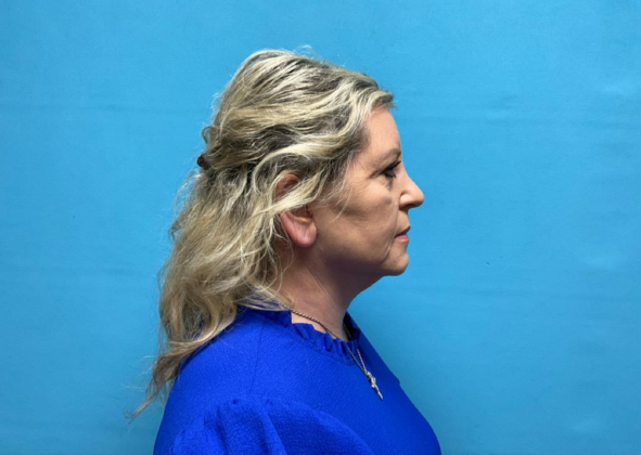 Facelift: Case 9 - After