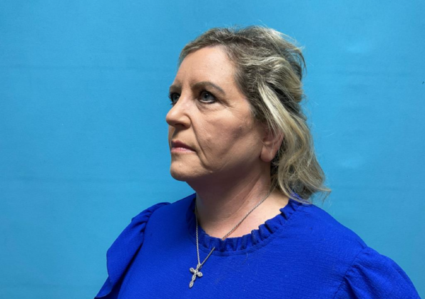 Facelift: Case 9 - After