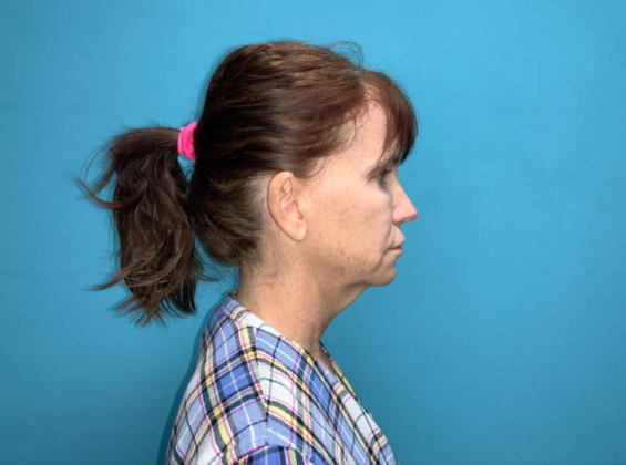 Facelift: Case 6 - Before