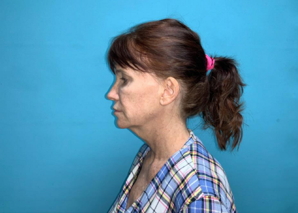 Facelift: Case 6 - Before