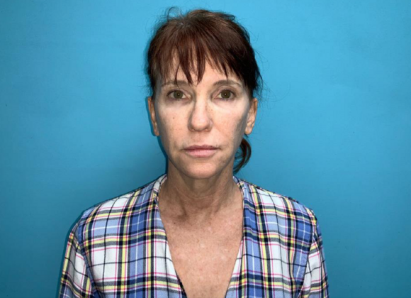 Facelift Case 6 - Before