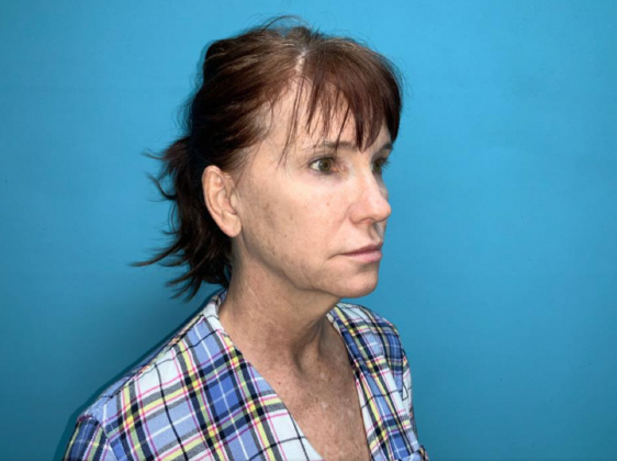 Facelift: Case 6 - Before