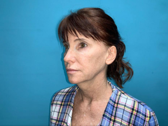 Facelift: Case 6 - Before