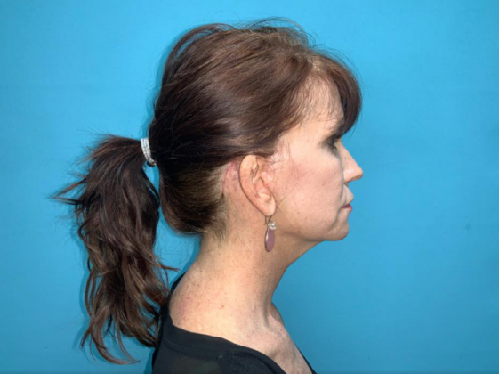 Facelift: Case 6 - After