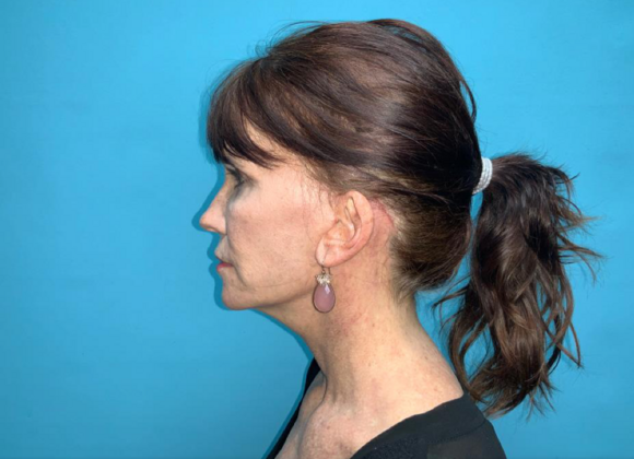 Facelift: Case 6 - After