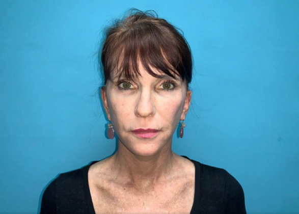 Facelift Case 6 - After