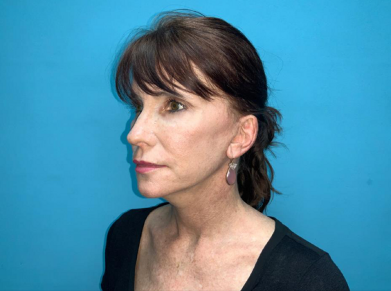 Facelift: Case 6 - After