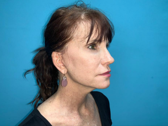 Facelift: Case 6 - After