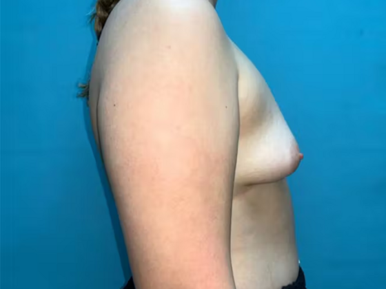 Breast Augmentation: Case 17 - Before