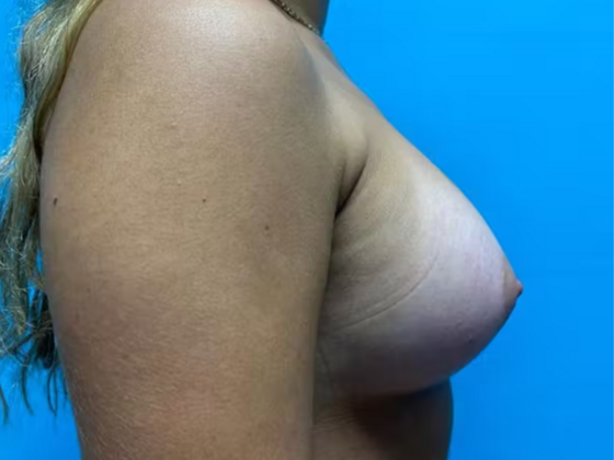 Breast Augmentation: Case 22 - After