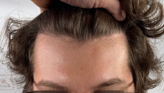 FUE Hair Restoration: Case 46 - After