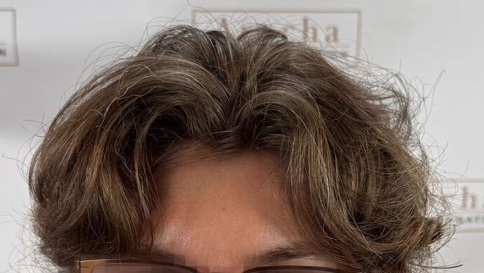 FUE Hair Restoration: Case 46 - After