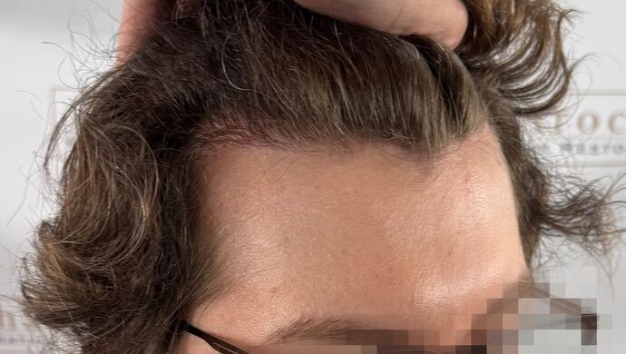 FUE Hair Restoration: Case 46 - After