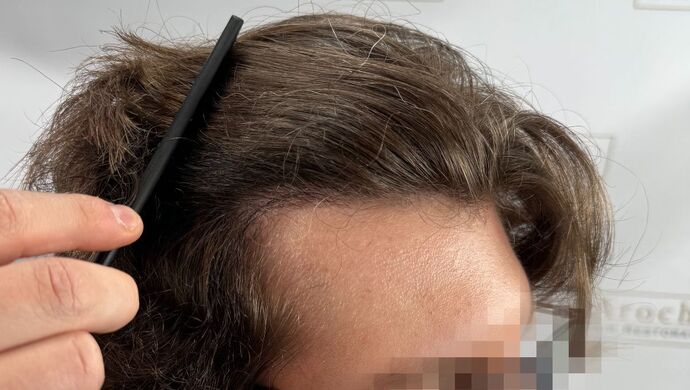 FUE Hair Restoration: Case 46 - After
