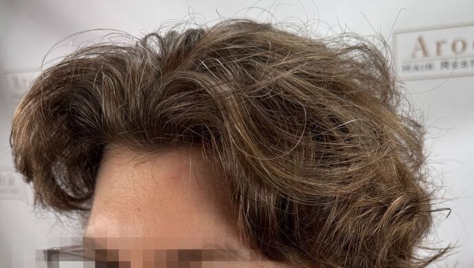 FUE Hair Restoration: Case 46 - After