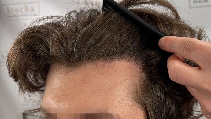 FUE Hair Restoration: Case 46 - After