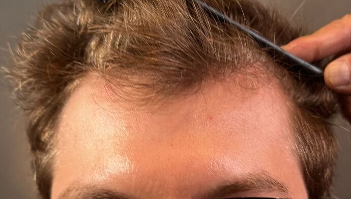 FUE Hair Restoration: Case 46 - Before