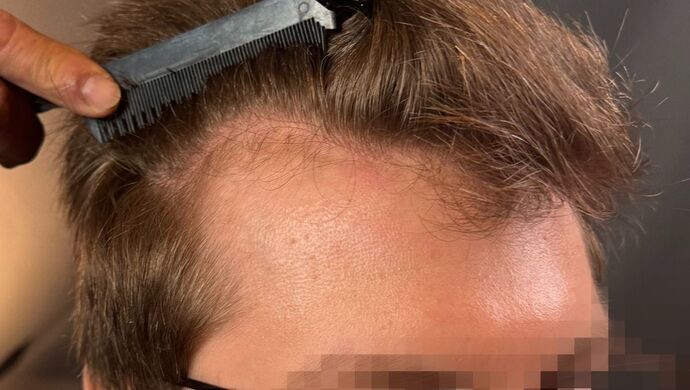 FUE Hair Restoration: Case 46 - Before
