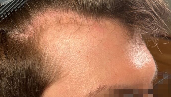 FUE Hair Restoration: Case 46 - Before