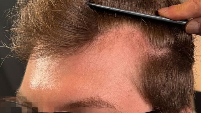 FUE Hair Restoration: Case 46 - Before